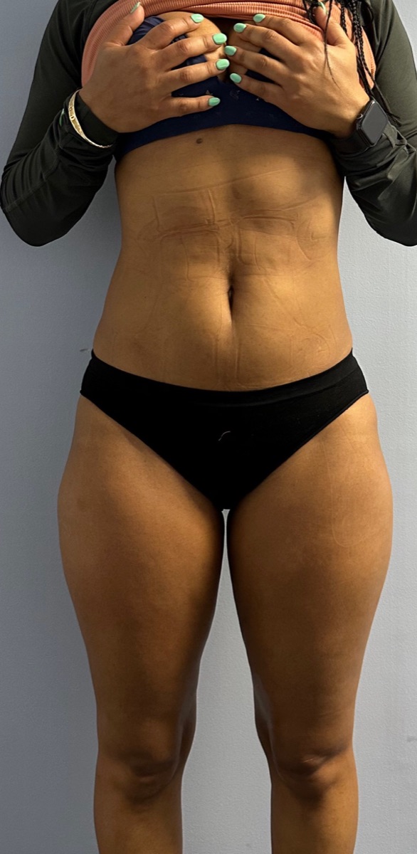 After: the same client's waist and stomach looking smoother and more defined
