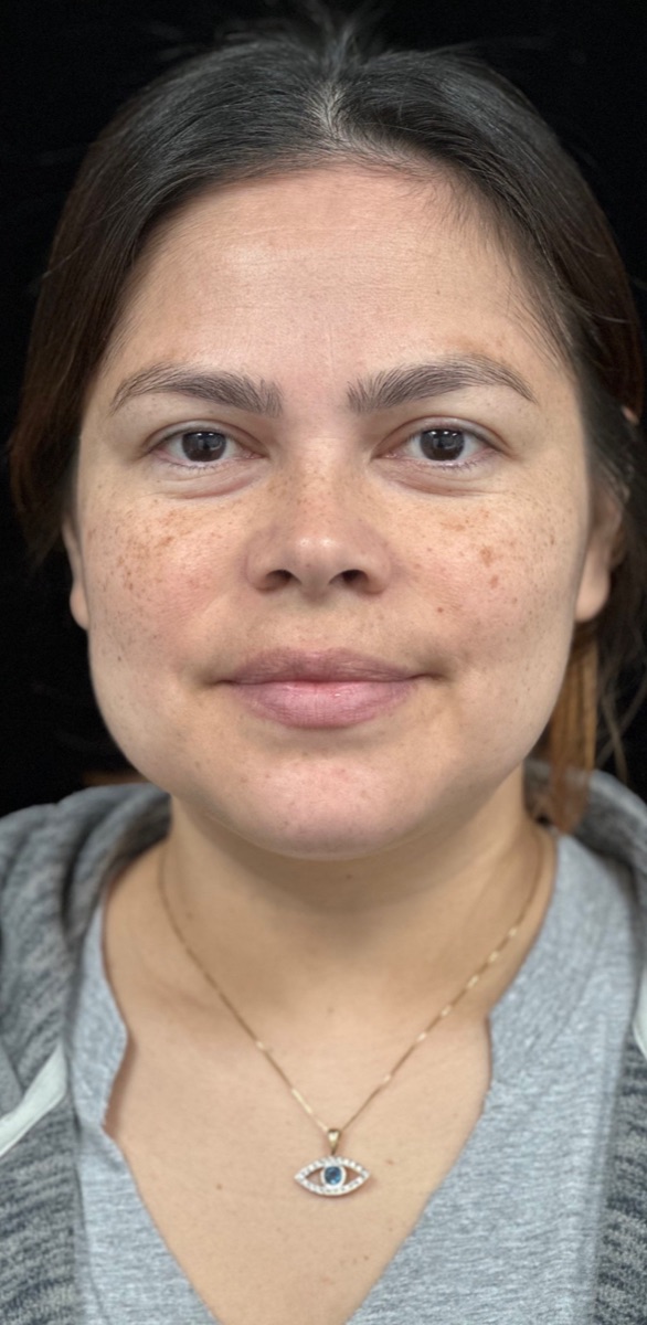 Before: a client's face with uneven tone and freckling