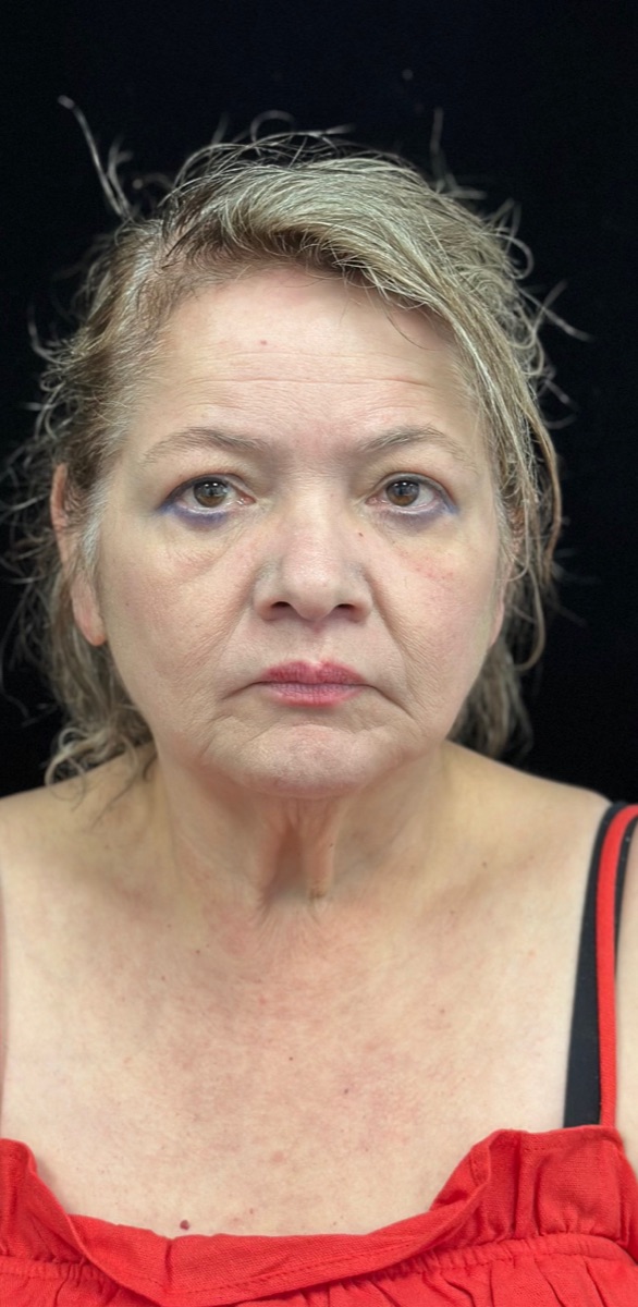 Before: a client's face and neck