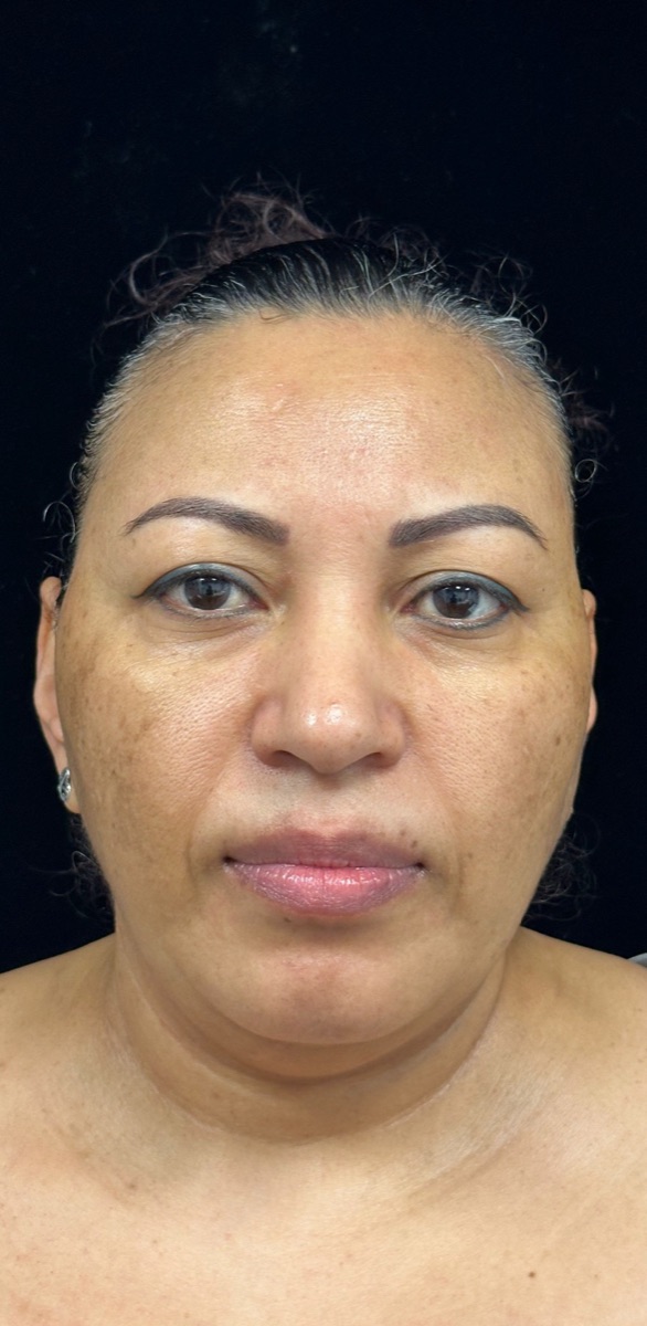 Before: a client's face with dark spots
